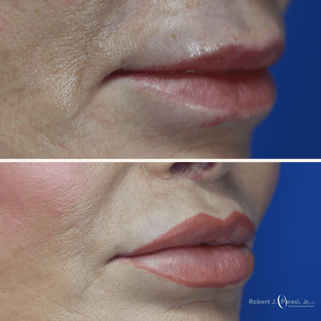 Lip Lift